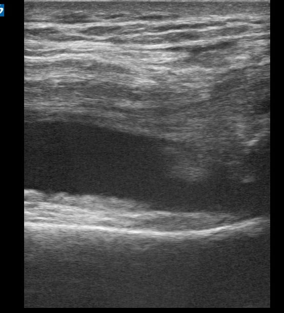 Knee Effusion4 (Traumatic) - Video