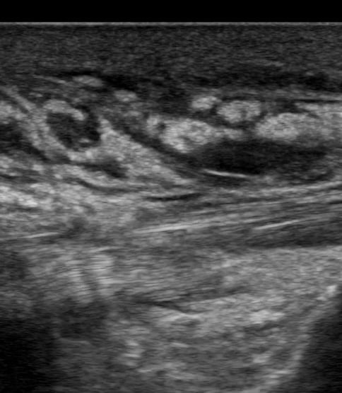 Atfl Tear7 (Partial) - Video