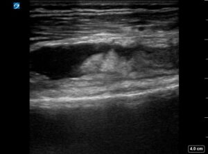 Knee effusion - Global Ultrasound Institute
