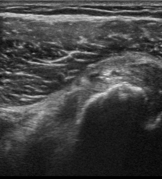 Partial Supraspinatus Tear8 (5 Weeks S/P Fall) - Video