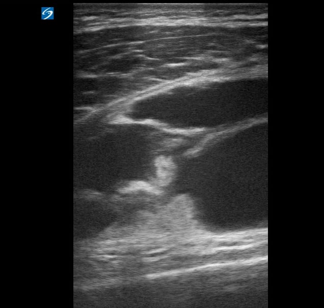 Quad Tendon Tear + Septic Joint4 - Video
