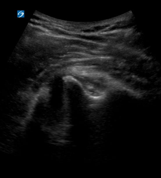 Anterior Shoulder Dislocation With Hematoma3 (Posterior View) - Video