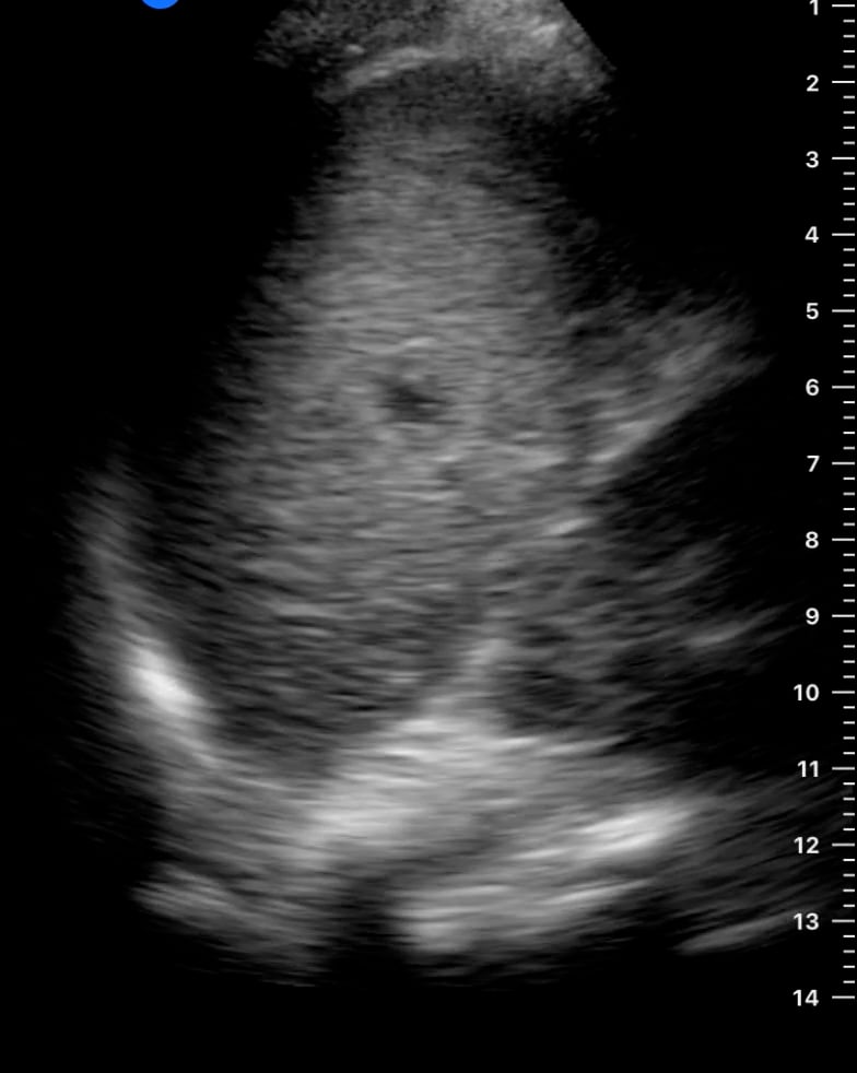 Luq (-) Ascites1 - Video