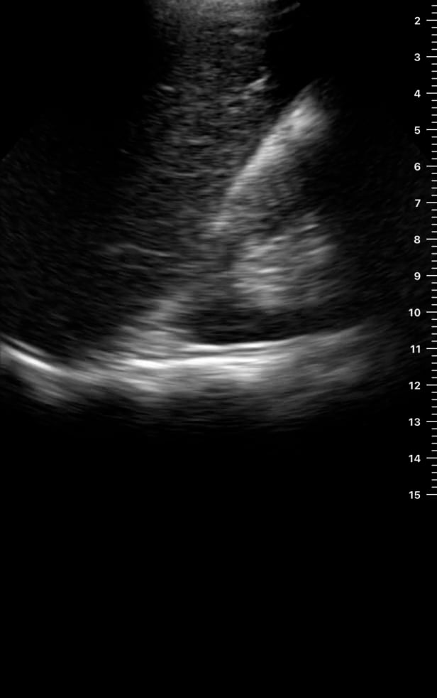 Ruq (-) Ascites1 - Video