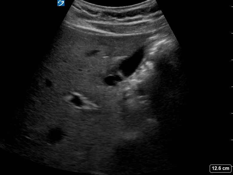 Normal Gallbladder33 (Exclamation Point Sign) - Video