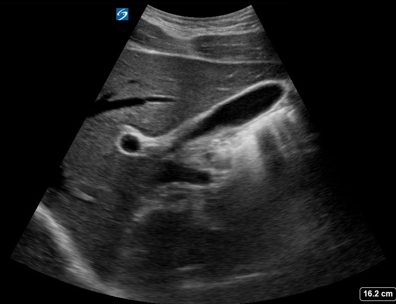 Normal Gallbladder40 (Exclamation Point Sign) - Video