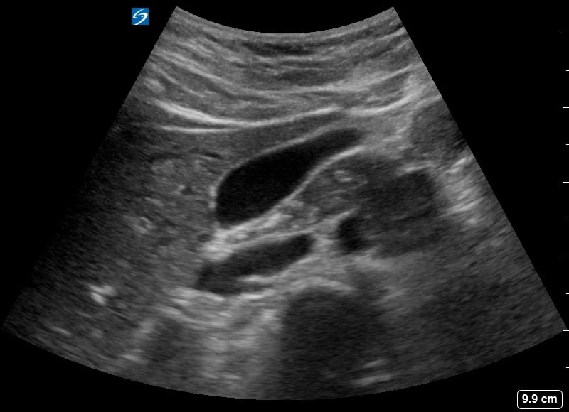Normal Gallbladder13 (Ivc Visible) - Video
