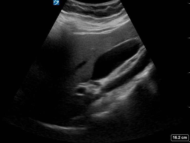 Normal Gallbladder32 (Long Axis