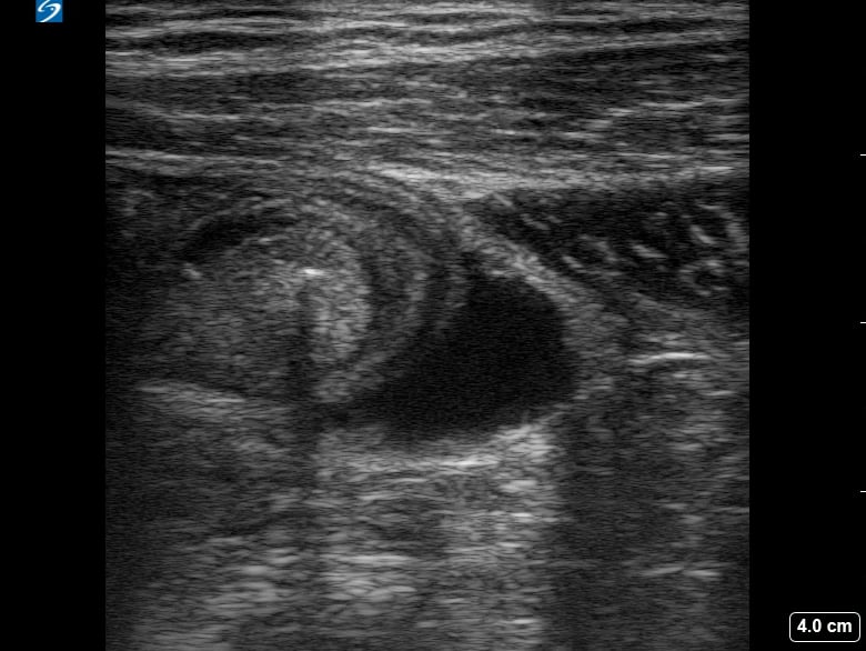 6Wk Iup With Ovarian Cyst2 - Video