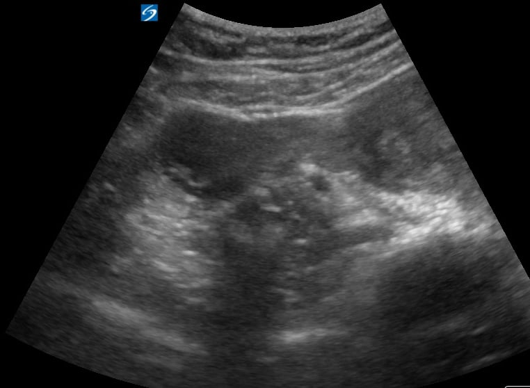 9Wk Iup With Ovarian Cyst1 - Video