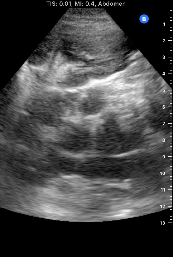 Tb Para-Aortic Lymphadenopathy - Video