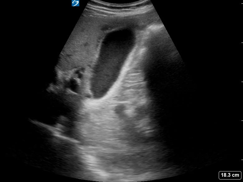 Pericholecystic Fluid1 - Video
