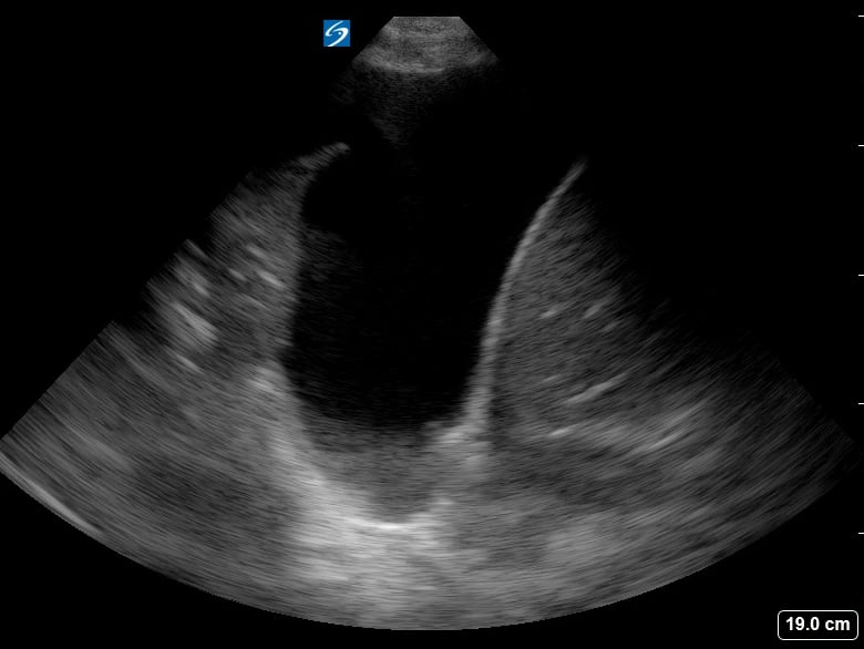 Pleural Effusion + Atelectasis16 (+Spine Sign) - Video