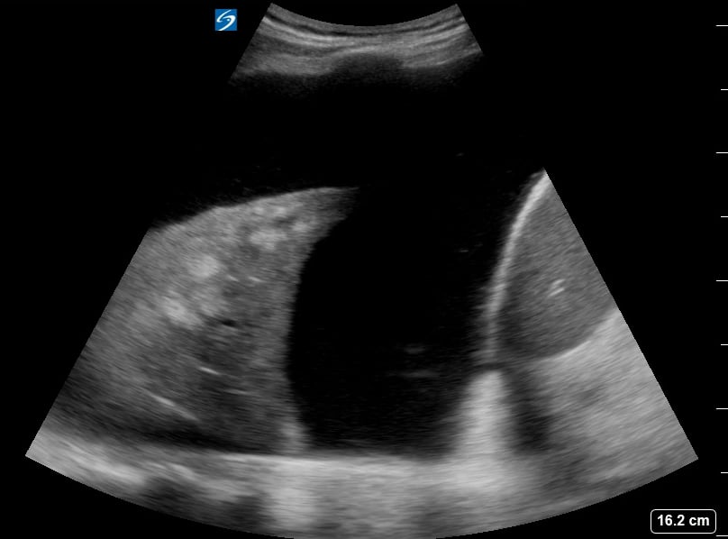 Pleural Effusion + Atelectasis14 (+Spine Sign) - Video