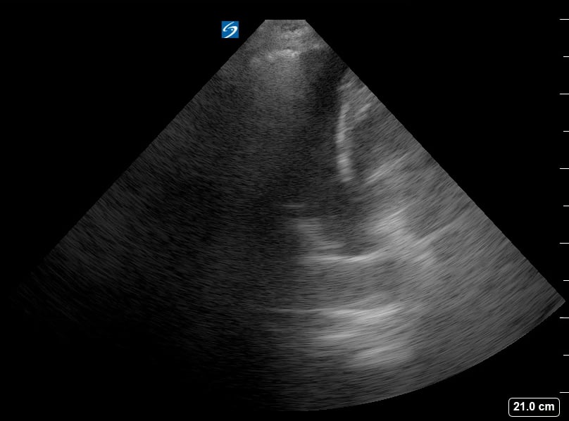 Pleural Effusion + Consolidation8 (+B Lines) - Video