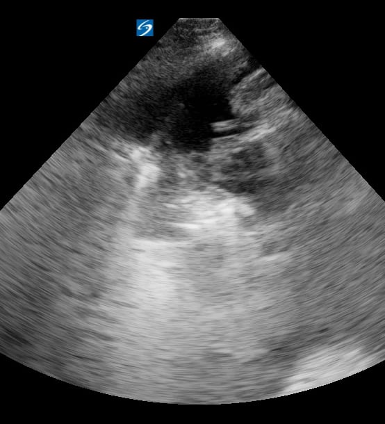 Malignant Pleural Effusion1 - Video