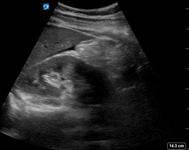 Posfasthemorrhagicystonapixiban_Crop - Video