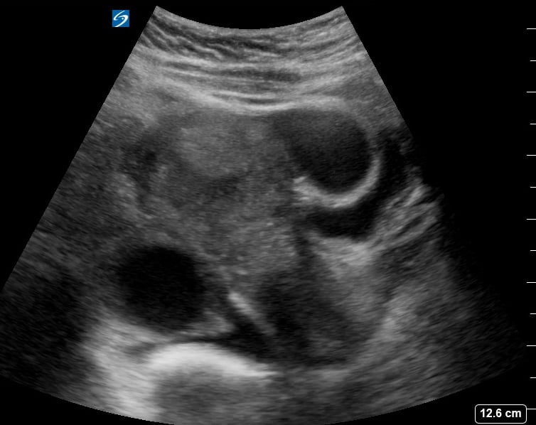 Pelvic Free Fluid6 (Ruptured Ectopic Pregnancy) - Video