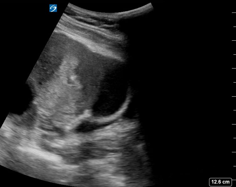 Pelvic Free Fluid8 (Ruptured Hemorrhagic Ovarian Cyst) - Video