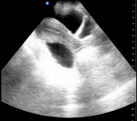 Free Fluid: Present - Video