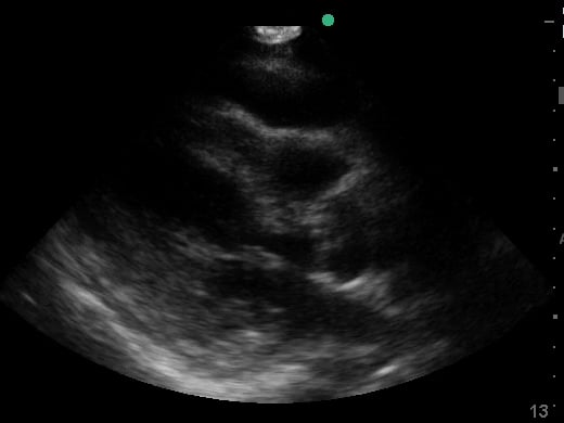 Plax Pericardial Effusion5 (+Cardiac Tamponde