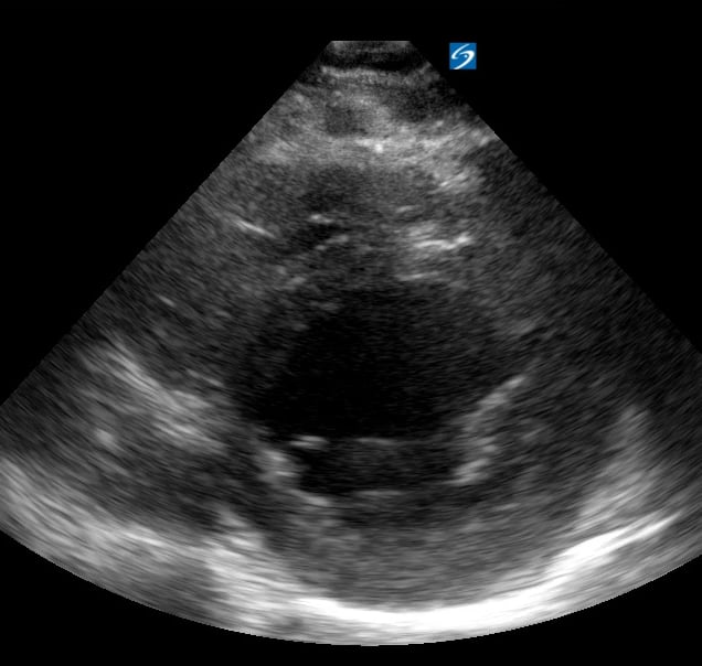 Plax Depressed Ef11 (Ef ~20%