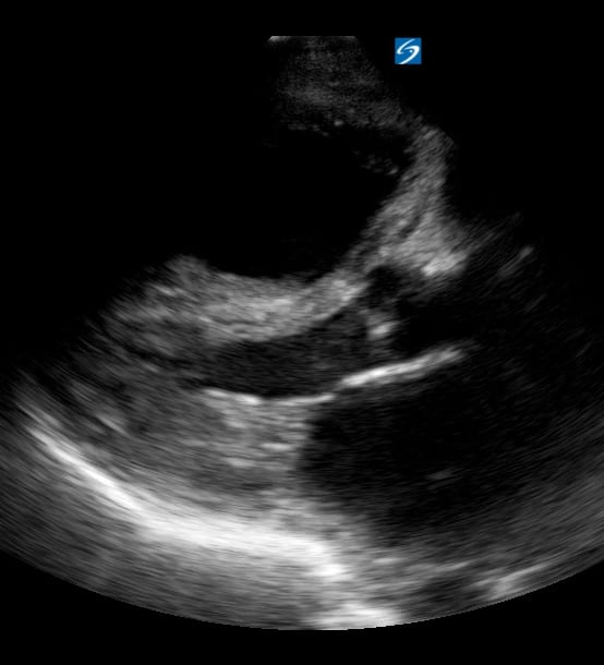 Plax R Heart Strain2 - Video
