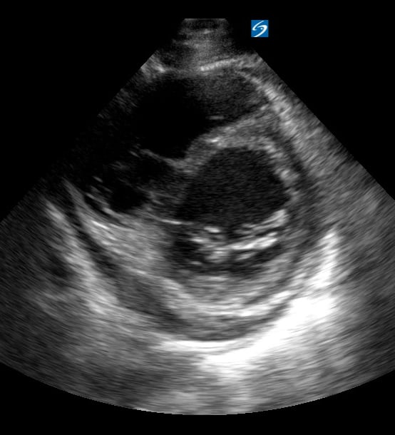 Psax Depressed Ef4 (Ef ~15%