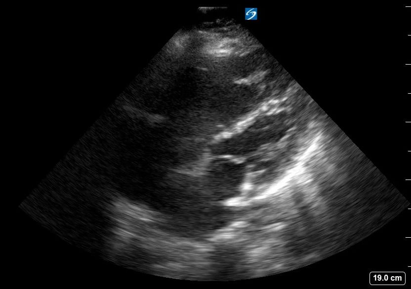 A4C R Heart Strain12 - Video